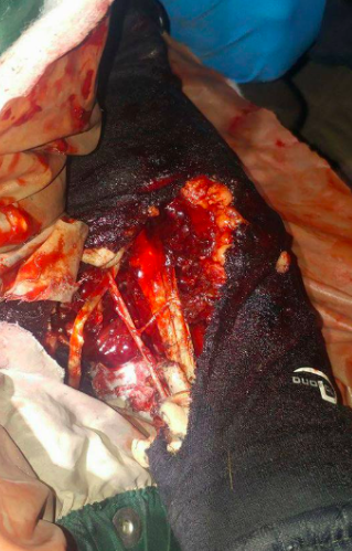 The grenade wound suffered by Sophia Wolansky blew away the muscle, exposing bone, looking like a war injury, not typical police