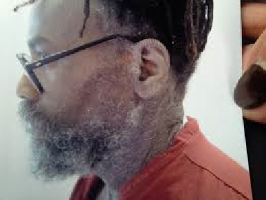 Photo showing part of the serious skin rash suffered by Mumia Abu-Jamal, traced to his untreated Hep-C infection. Prison lawyers sought unsuccessfully to have it barred as evidence at his hearing, claiming it was 'inflammatory'