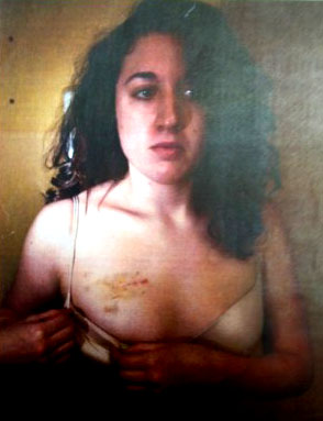 Photo of Cecily McMillan showing the bruises and abrasions on her right breast caused by an officer's grabbing her from behind